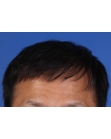 After Hair Transplant  2 Sessions (Areas)